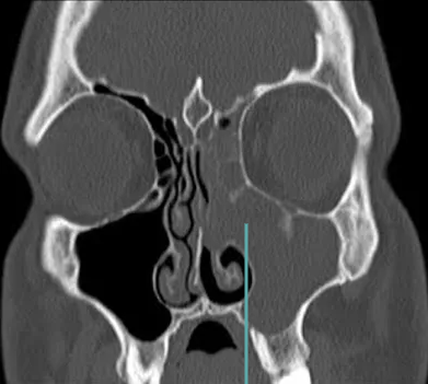 tomografia cirurgia de sinusite crônica